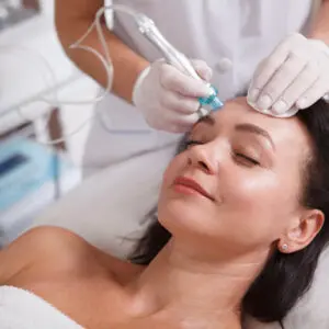 Woman receiving microneedling facial treatment