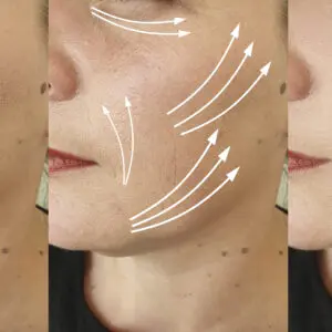 Facial skin tightening before and after